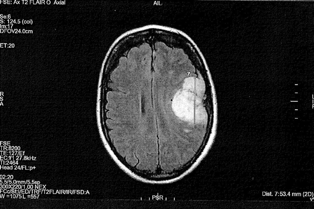 Androcur : une plainte déposée par les victimes du médicament pour mise en danger d’autrui et tromperie aggravée