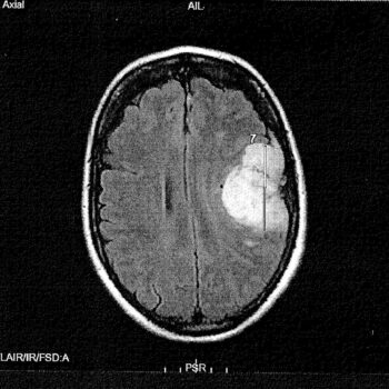 Androcur : une plainte déposée par les victimes du médicament pour mise en danger d’autrui et tromperie aggravée