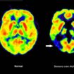 Haben die Amyloid-Plaques schon irreversible Schäden im Gehirn angerichtet, nützt ihre Entfernung nichts mehr. (Archivbild) Foto