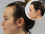 Inside the rise of female hair transplants: Doctor reveals three things causing women's receding hairlines - as patients claim the £10,000 procedure should be treated 'the same' as breast enlargements