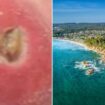 Horror warning as sickening flesh-eating ulcer disease starts spreading in UK holiday hotspot