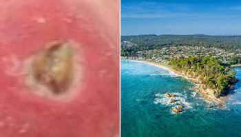 Horror warning as sickening flesh-eating ulcer disease starts spreading in UK holiday hotspot