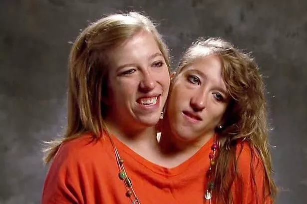 How can conjoined twins have a baby as world-famous Hensel sisters spark rumours