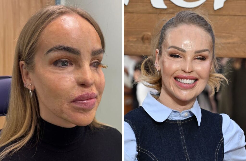 Katie Piper reveals decision to be fitted with ‘artificial eye’ 16 years after acid attack