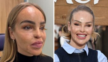 Katie Piper reveals decision to be fitted with ‘artificial eye’ 16 years after acid attack