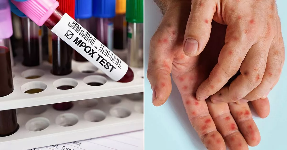 Another case of 'most dangerous yet' strain of Mpox confirmed in UK by health officials