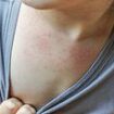 Key change to the SKIN that's a little-known sign of hMPV, study reveals - as cases continue to spike