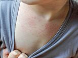 Key change to the SKIN that's a little-known sign of hMPV, study reveals - as cases continue to spike