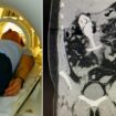 Woman's three horrifying symptoms after sex toy 'dragged through body' in MRI scan