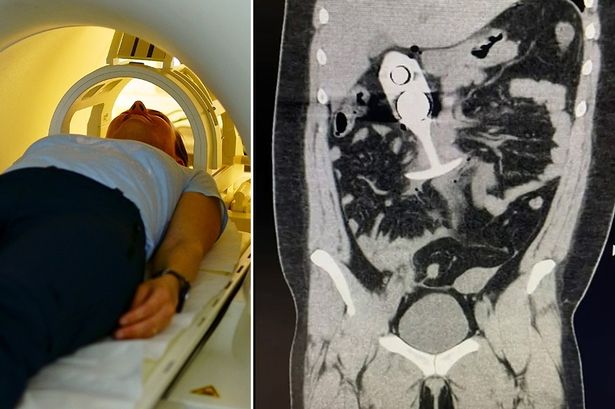 Woman's three horrifying symptoms after sex toy 'dragged through body' in MRI scan