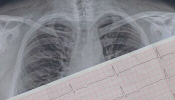 Cardiologist warns of 'very dangerous and harmful' mistake over heart palpitations